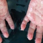Monkeypox Outbreak: U.S declares public health emergency