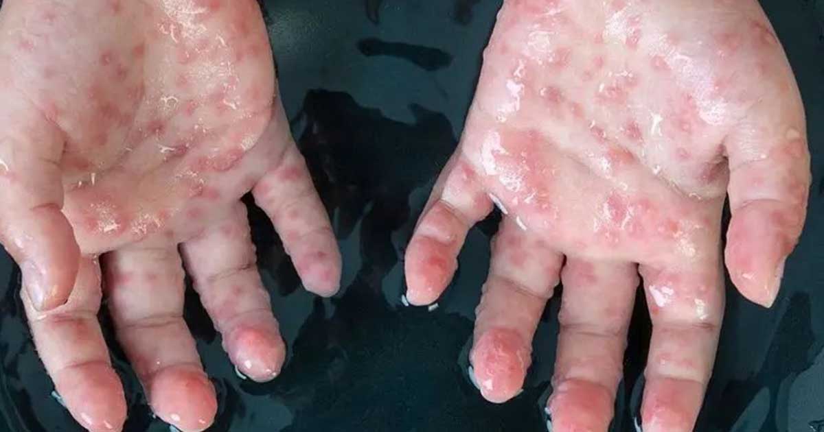 Monkeypox Outbreak: U.S declares public health emergency