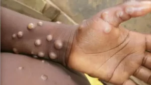 Monkeypox outbreak likely spread by sex, says WHO expert